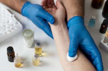 Profissional da saúde realiza avaliação de reação alérgica no antebraço de um paciente durante atendimento em Alergia e Imunologia, com materiais para testes alérgicos e amostras laboratoriais sobre a bancada.