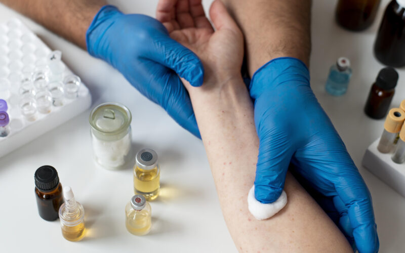 Profissional da saúde realiza avaliação de reação alérgica no antebraço de um paciente durante atendimento em Alergia e Imunologia, com materiais para testes alérgicos e amostras laboratoriais sobre a bancada.